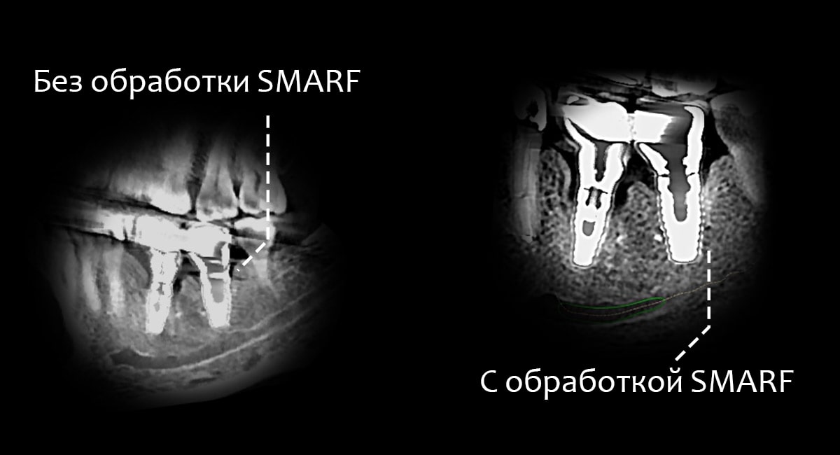 Функция SMARF Papaya 3D